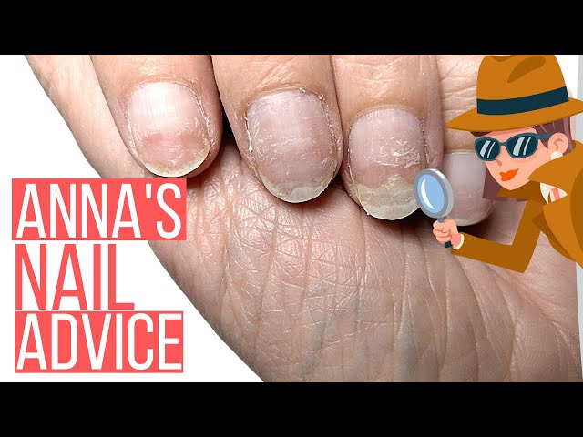 What causes yellow nails? – Dr. Dana