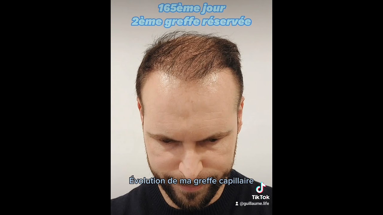 Évolution 1ère & 2nd greffe de cheveux 8m 