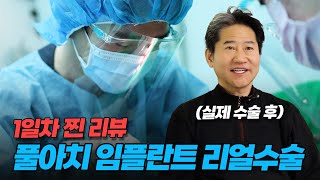 풀아치임플란트 리얼 후기! 1일차 통증·회복 모든 것 공개