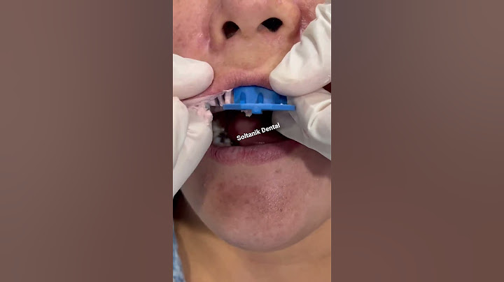 Taking a wow mold impression of teeth 💕 #shorts #viral #teeth #short