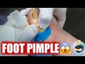 POPPING A HUGE BUMP ON A BIG TOE!!! ***WARNING: SUPER EXPLOSIVE***