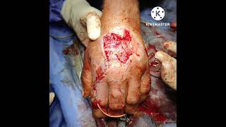 FDMA Fascial Flap for hand coverage