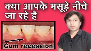 masudo ka niche jana || GUM RECESSION IN HINDI