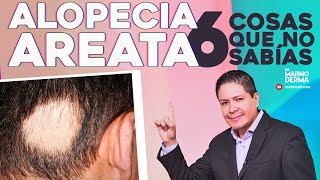 Alopecia Areata 6 Cosas Que No Sabias