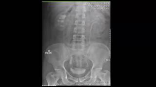 CASE 222 IVP immediate dense peristent nephrogram