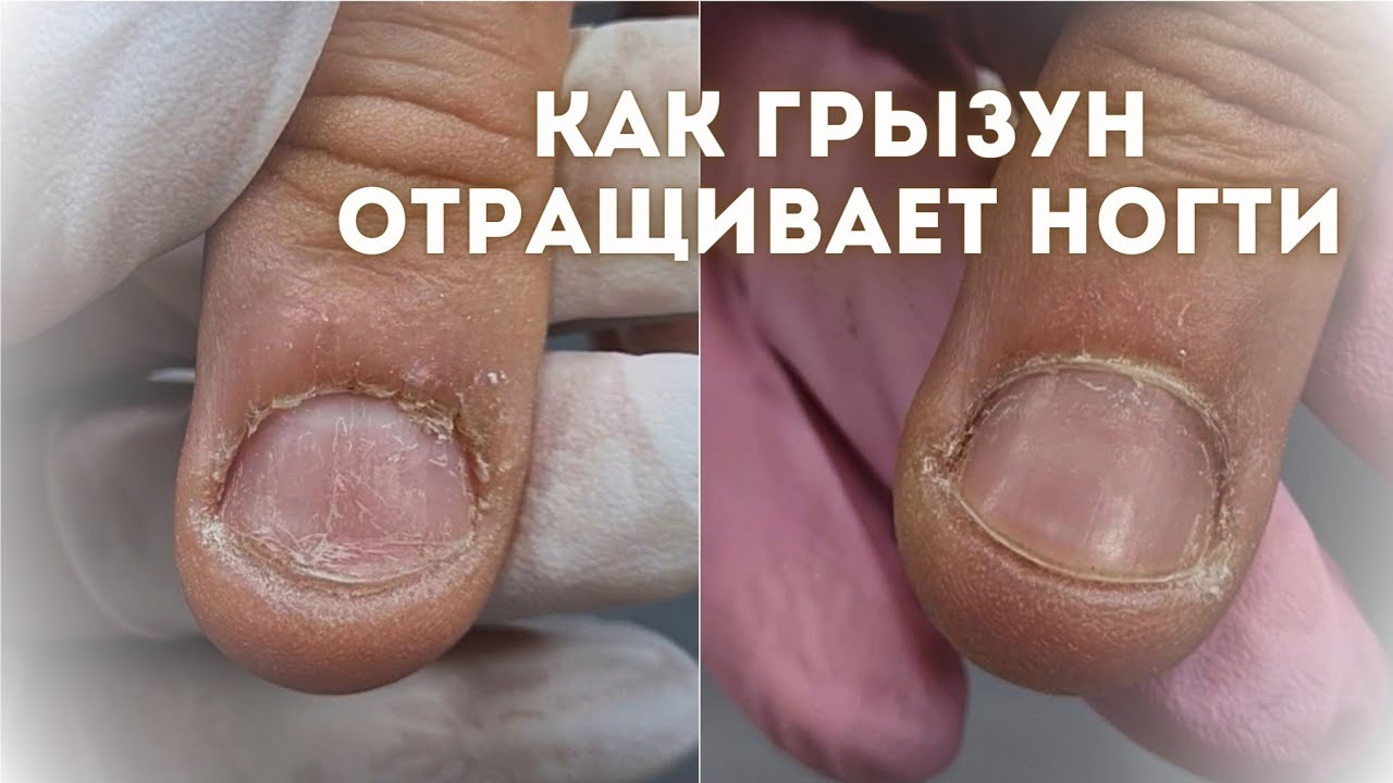 ГРЫЗУН ЧАСТЬ 2 🤓 Преображение ногтей грызуна. Мужской комбинированный ...