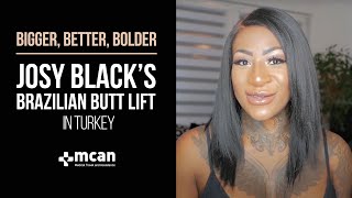Plastic Surgery In Turkey Josy Blacks Liposuction And Brazilian Lift Bbl With Mcan Health