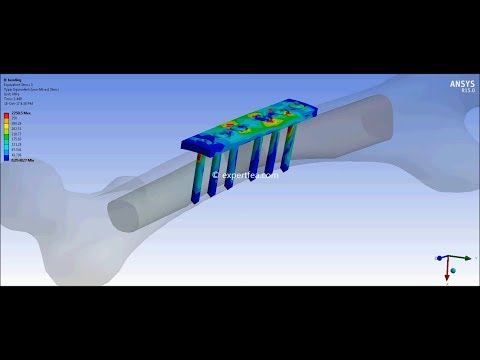 ANSYS WB Static Structural FEA - Extension, Bending and Torsion of a fractured femur with plate