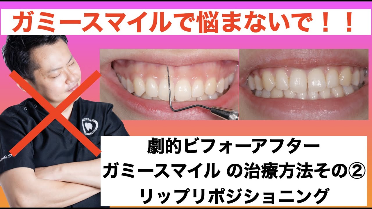 ガミースマイルで悩まないで！！ ガミースマイル の治療方法その② 劇