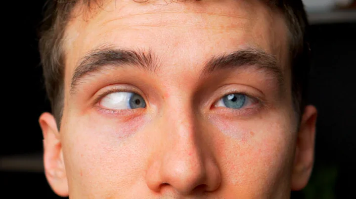 CROSS EYED? What is Strabismus - (Types, Causes, Treatments) Eye Doctor Explains - DayDayNews