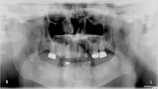 Quiz Bilateral Radiopacity Near Tmj