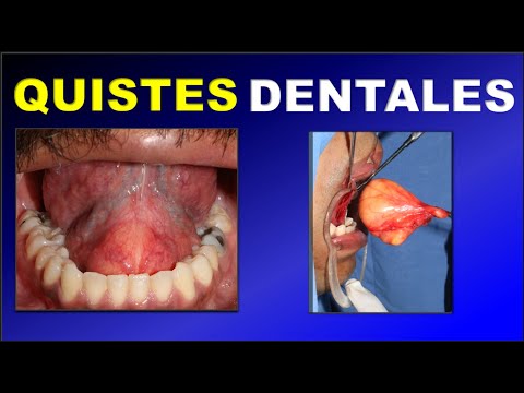 ODONTOGENIC CYST (DEVELOPMENTAL AND INFLAMMATORY DENTAL CYST)