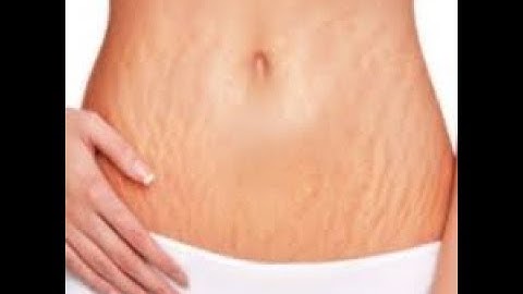 3 Step Home Treatment for Stretch Marks: Cocoa Butter