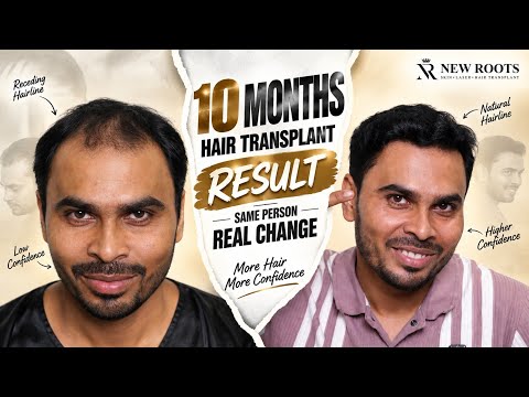 Hair Transplant Journey & Result | Real Patient Experience | Hair Transplant In Siliguri