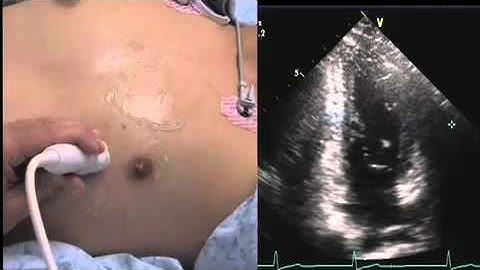 Scanning Apical 2CH View EchoVTorials.mov