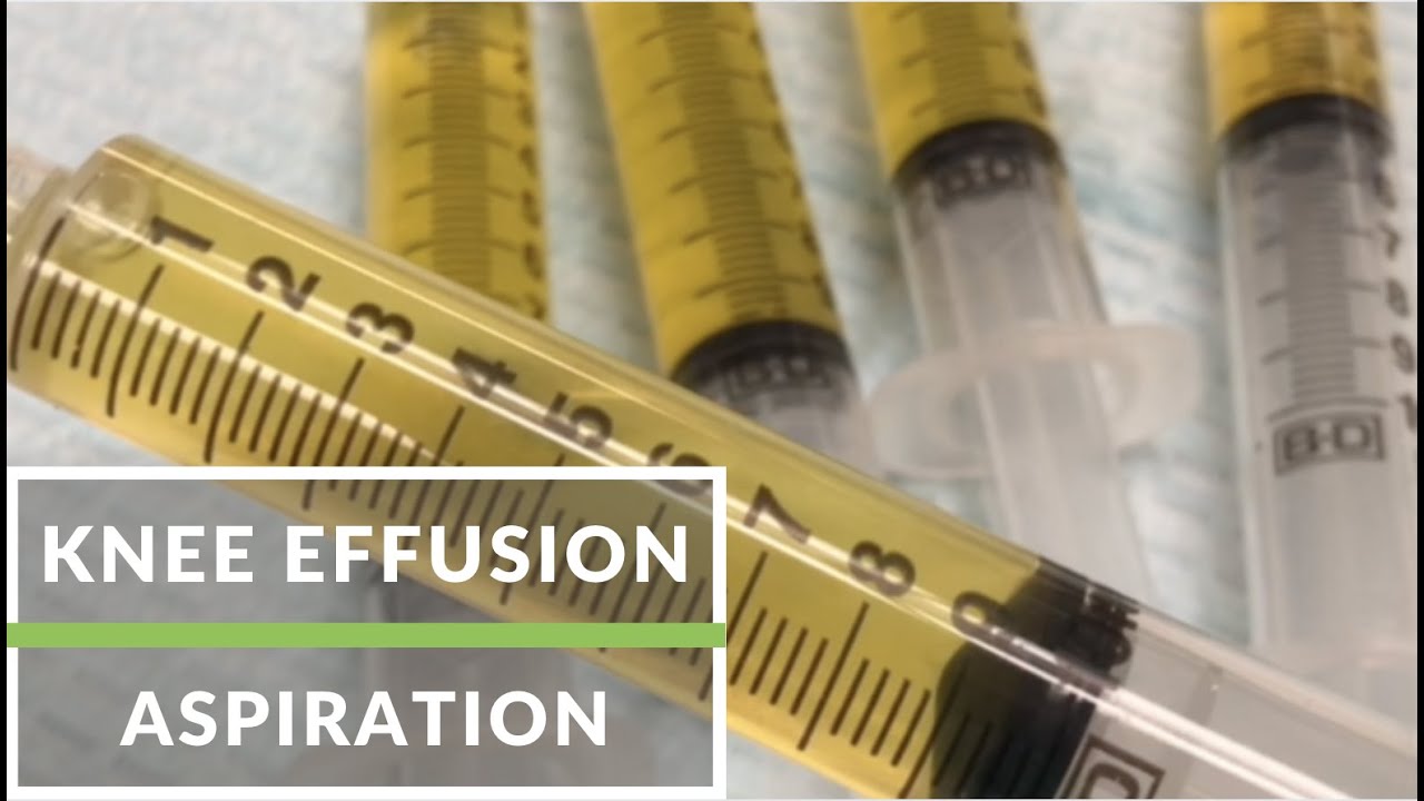 Knee effusion aspiration YouTube