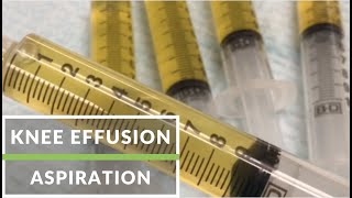 Knee Effusion Aspiration