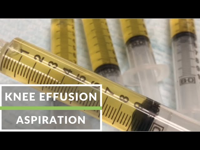 Knee effusion aspiration