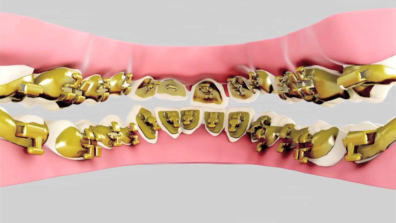 Incognito Lingual Braces Tom F. Hall DDS, MS, Orthodontist Houston, TX