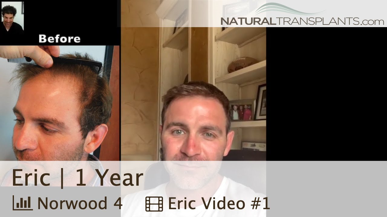Receding Hairline? No Problem: Permanent Solution with a Hair Transplant | Dr. Matt Huebner (Eric)