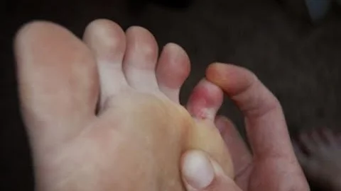 Pinky (5th) Toe Pain [ Best Home Treatment Guide]