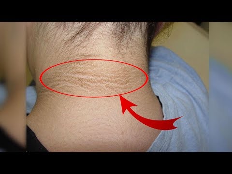 THE TRUTH! Get Rid Of Dark Neck Now! Easy And Natural...No Complications! | NATURAL SOLUTION