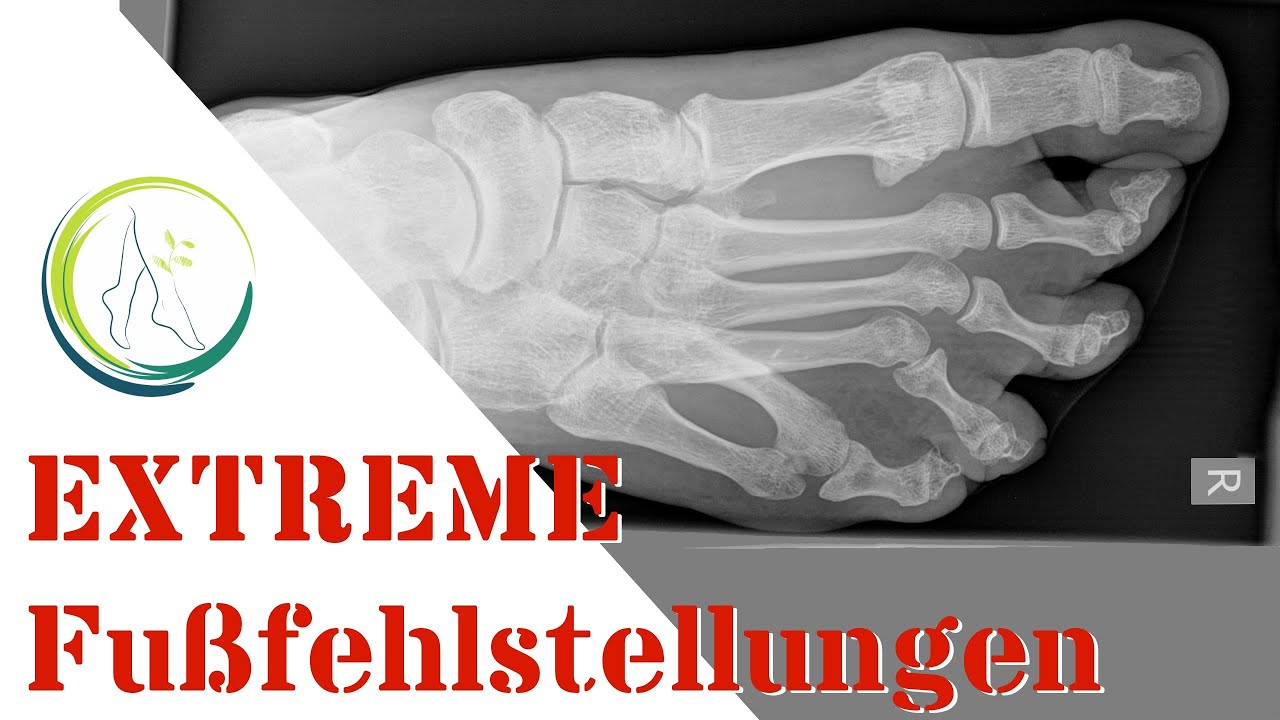 Extreme Fußfehlstellungen, Podologin Andrea erklärt - YouTube