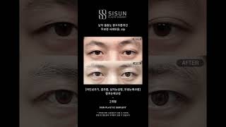 남자 돌출눈 몽고주름개선 무보정 사례모음. zip #시선성형외과 #shorts