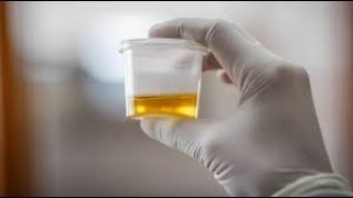 Urinalysis CPT codes - simplify medical coding
