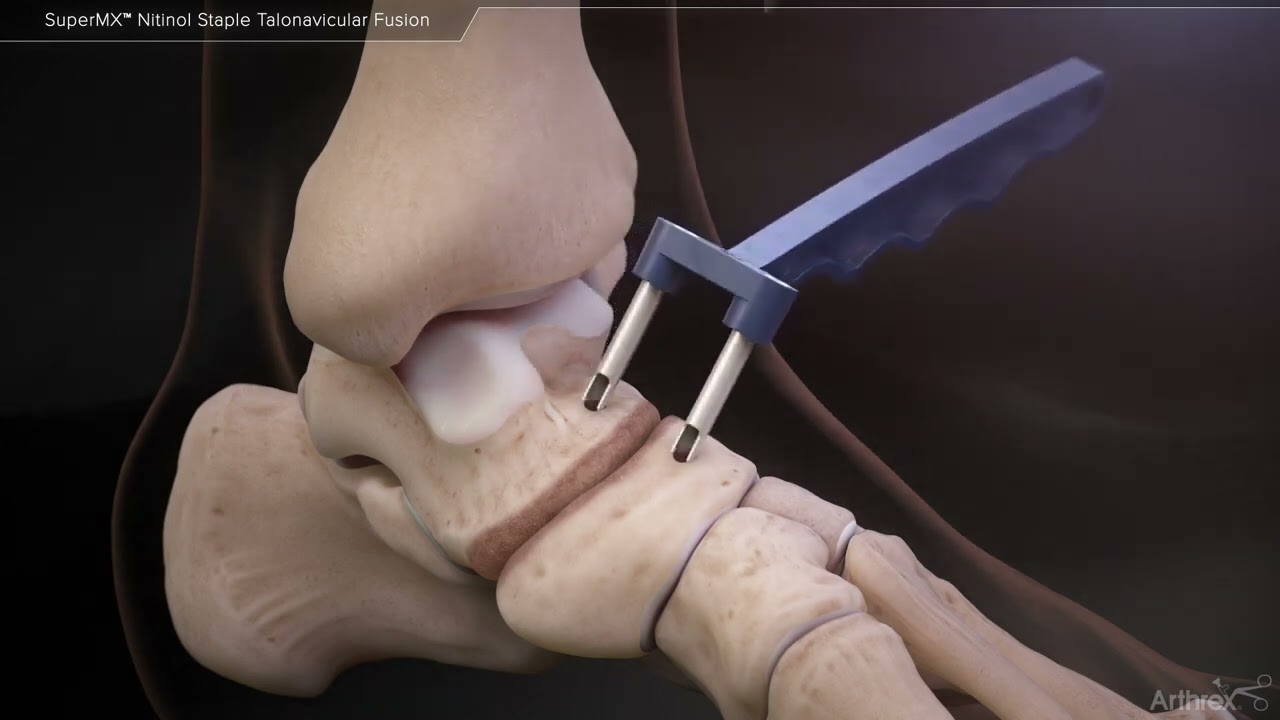 Arthrodèse talo-naviculaire (fusion) - Chirurgie de l'arthrose du pied - Dr Simon Tournemine