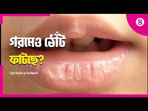 ভিডিও: ঠোঁট ফাটা কেন হয়?