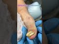 ТОЛСТЫЙ НОГОТЬ БУДЕТ ТОЛЬКО В СТАРОСТИ? WILL YOU ONLY HAVE A THICK NAIL IN OLD AGE?  #shortsvideo