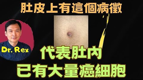 (中英字幕EngSub) 肚皮上出现这个病征，代表癌症晚期！Watch out for this bump on the belly button it may mean cancer - 天天要闻