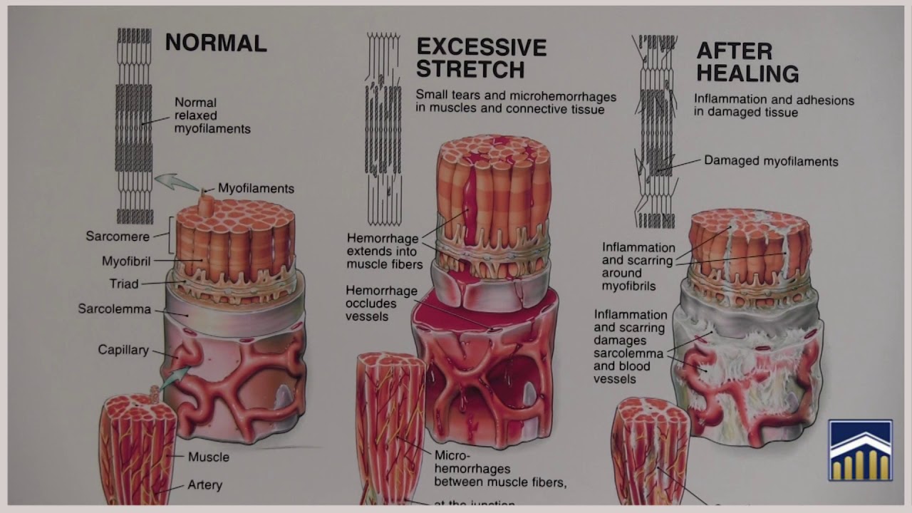 muscle tear