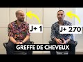 Greffe de cheveux  les rsultats dune fue dhi  jour 1 