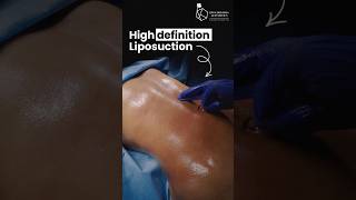 The right candidate for High-Definition Liposuction? #Liposuction #BodyContouring #PlasticSurgery