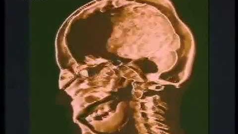 Wilhelm C Roentgen   X Rays