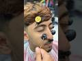The removal of the blackhead from the face😳✂️#fyp #foryou #foryoupage #viral #explore #comedy #asmr