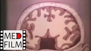 Декомпрессионная трепанация черепа по Кушингу © Decompression craniotomy for Cushing