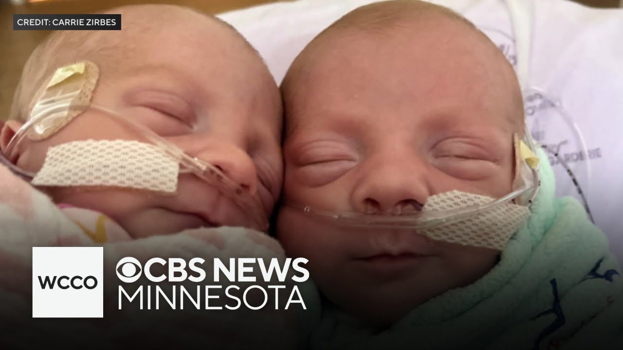 Minnesota woman gives birth to ultra rare mono mono twins 썸네일