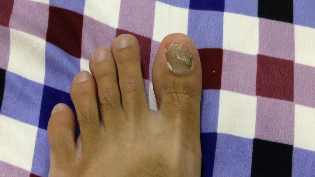 TOENAIL CUTTING and clean Extreme Dead Skin Removal Toenail