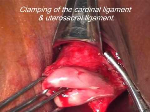 PART 1 REMOVING THE UTERUS BY VAGINAL APPROACH USING SUTURES - YouTube