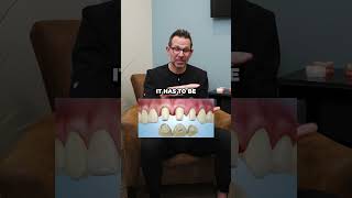 Do #Veneers cause your real teeth 🦷 to decay underneath? Listen👂to find out #dentist #dentalcare Wealth