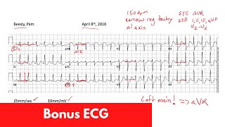 ECG Basics | Systematic Approach | For DO, MD, NP, PA