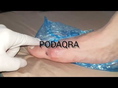 picioarele reci și vene varicoase rularea picioarelor în varicoză