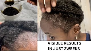 I Was Bald For 6 Months And Grew My Hair Fast! Don’t Wash This Out Your Hair Will Go Crazy!