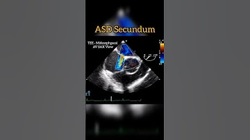 ASD Secundum on TEE Midesophgaeal Aortic Valve Short Axis View #echocardiography