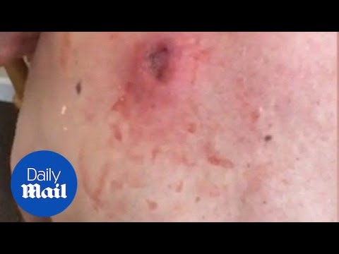 Gross moment a cyst is popped pus - YouTube