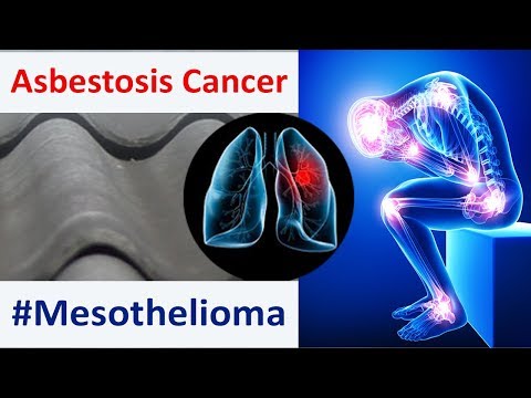 asbestos-cancer-–-main-causes-and-mesothelioma-symptoms-for-this-asbestosis-cancer-disease