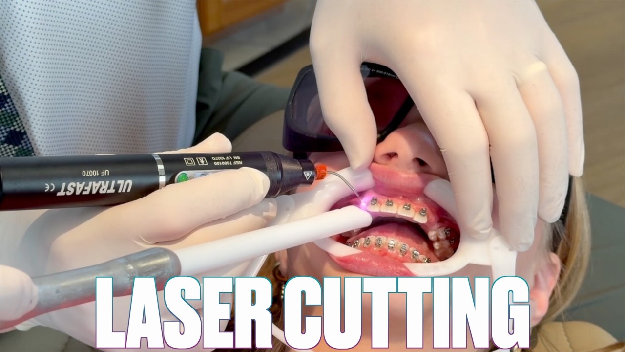 USING A HOT LASER TO CUT HER GUMS BACK AND PULL DOWN STUBBORN TEETH AT THE ORTHODONTIST